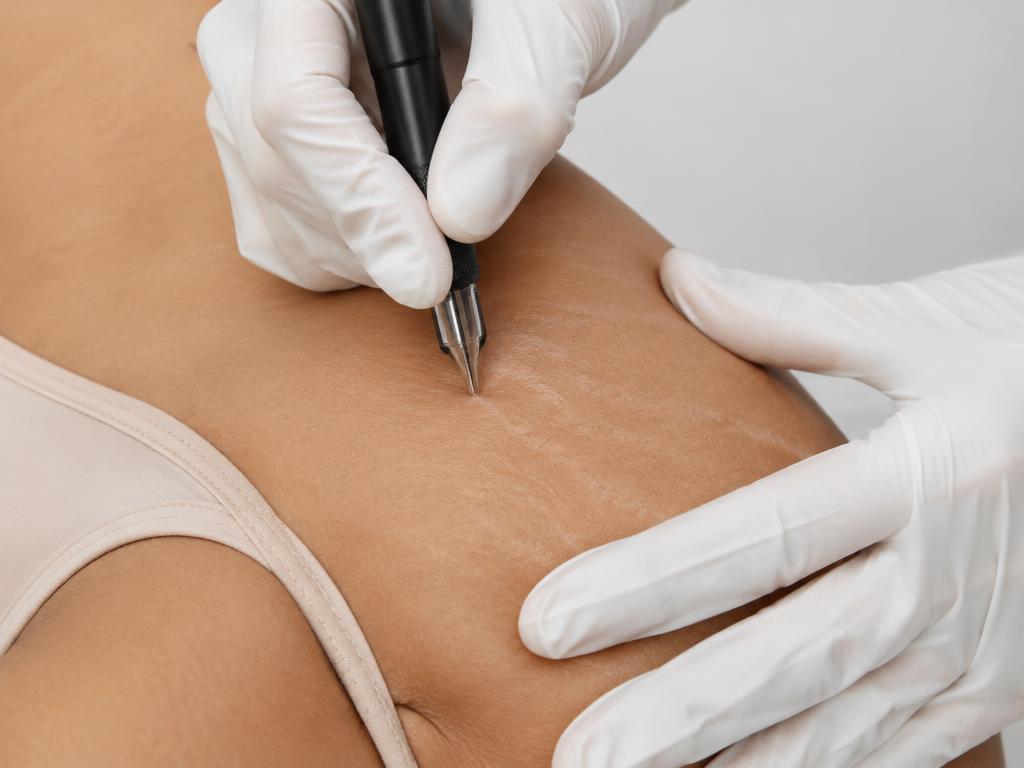 Profissional aplicando pigmento de camuflagem estética sobre estrias
