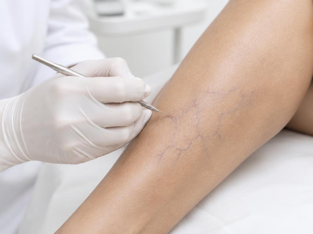 Profissional realizando procedimento de secagem de vasinhos na perna